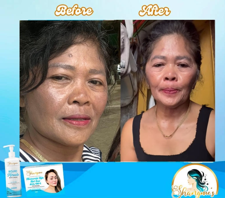 Kojic Acid Niacinamide Organic allin1 miracle soap effective for Melasma, Pimples, Darks Spots, Smooth and Soft Skin, Glass skin&whitening effect, skin diseases, allergies dandruff, feminine hygiene face and body and many more skin benefits.(135grams)
