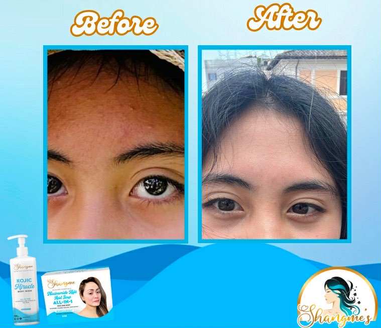 Kojic Acid Niacinamide Organic allin1 miracle soap effective for Melasma, Pimples, Darks Spots, Smooth and Soft Skin, Glass skin&whitening effect, skin diseases, allergies dandruff, feminine hygiene face and body and many more skin benefits.(135grams)