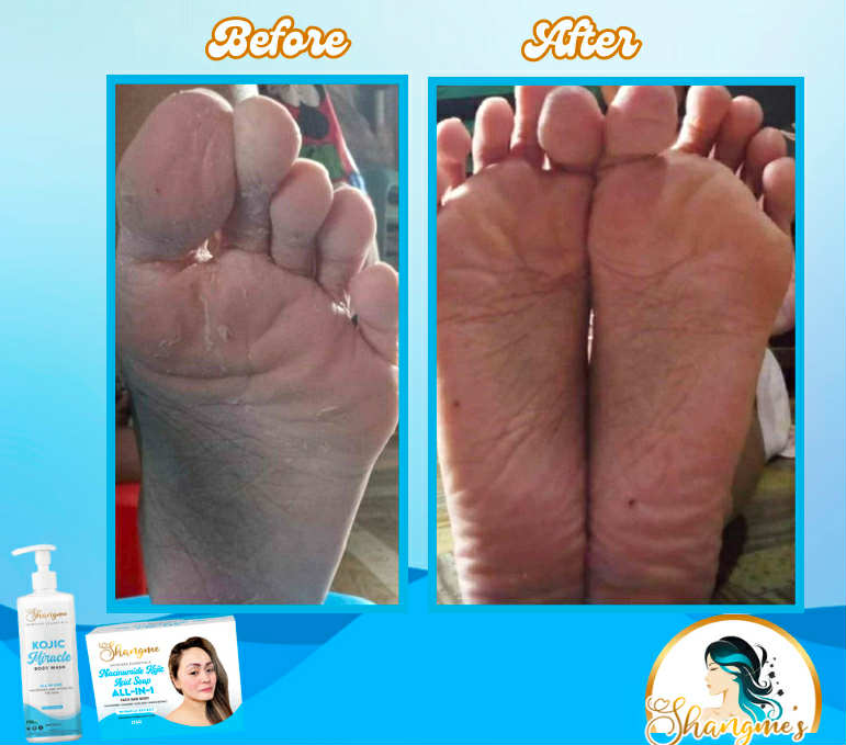 Kojic Acid Niacinamide Organic allin1 miracle soap effective for Melasma, Pimples, Darks Spots, Smooth and Soft Skin, Glass skin&whitening effect, skin diseases, allergies dandruff, feminine hygiene face and body and many more skin benefits.(135grams)