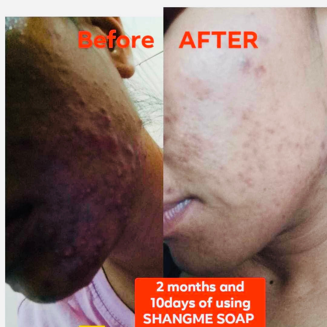 Kojic Acid Organic Body Wash allin1 the best and miracle effect for Melasma, Pimples, Darks Spots, Smooth&Soft Skin, Glass skin&whitening effect,skin diseases, allergies dandruff, feminine hygiene face and body and many more skin benefits.(135grams)